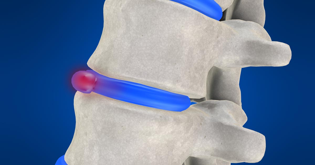 Redondo Beach non-surgical disc herniation treatment